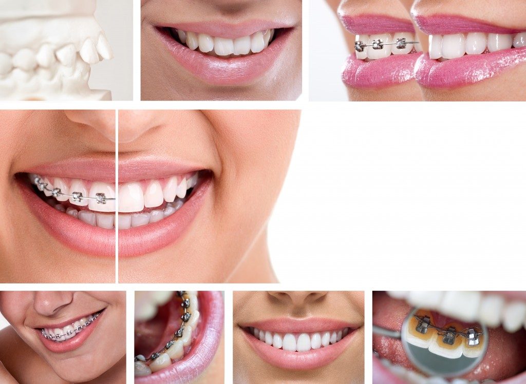 dental braces - lingual braces, before and after