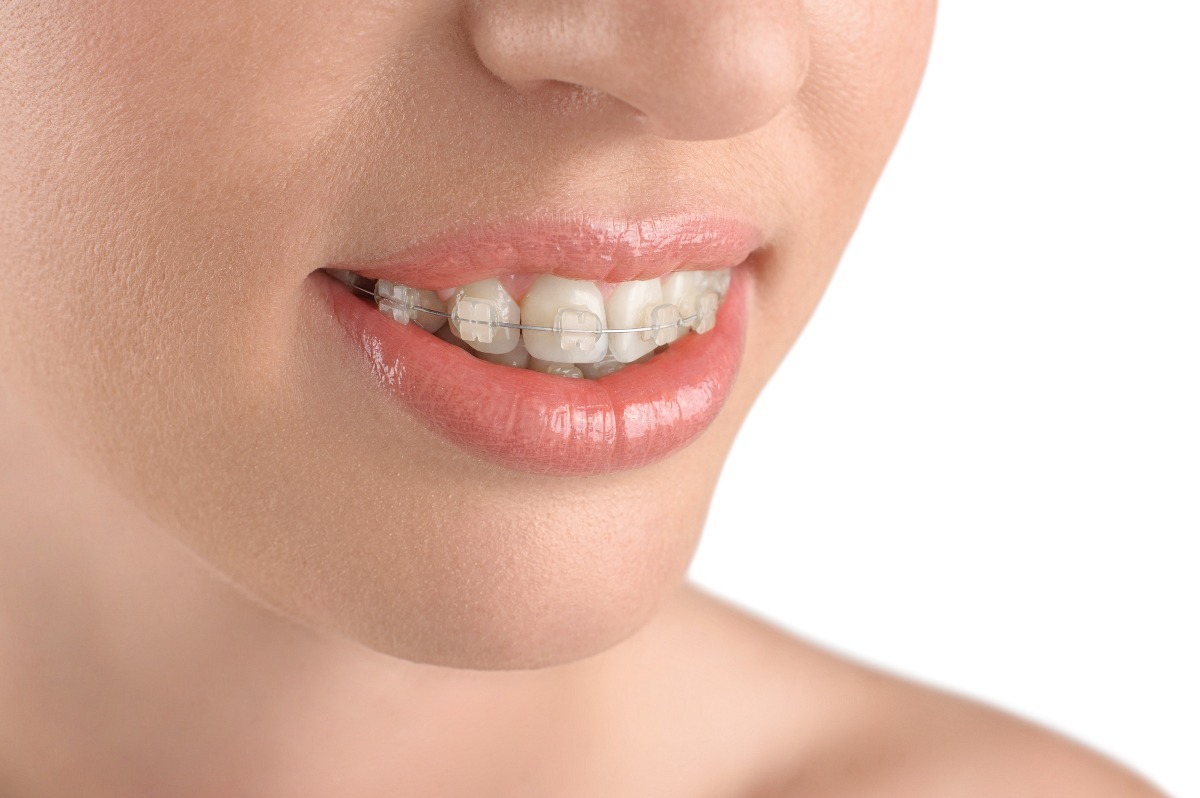 woman wearing braces