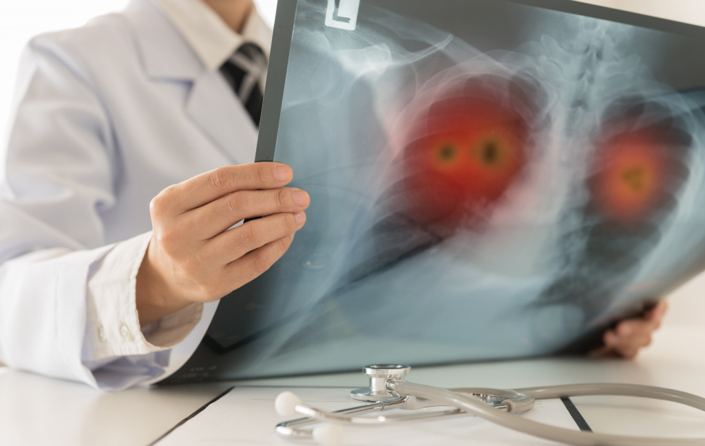 Lung cancer X-ray